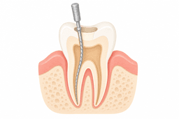 Root canal