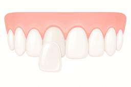 Veneers