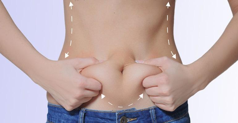 Tummy Tuck