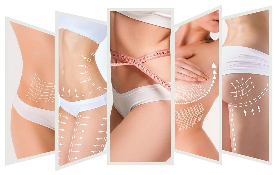 Body Lift Surgery