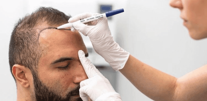 Hair Transplantation
