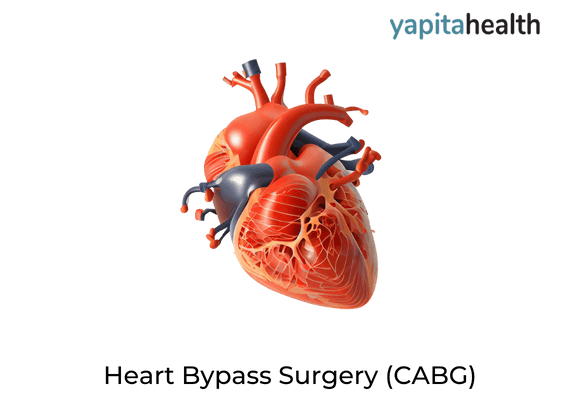 Heart Bypass Surgery (CABG)