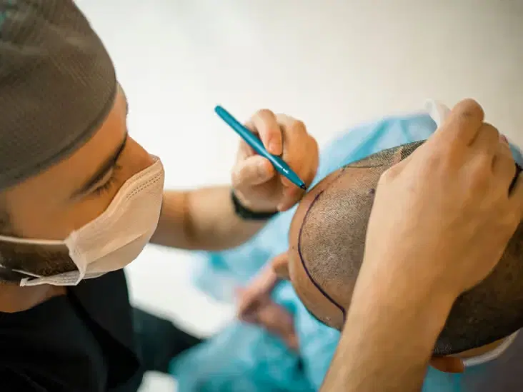 Hair Transplant in Santa Clara, California