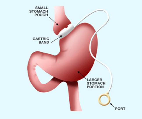 Gastric Banding Surgery at Asian Institute of Medical Sciences, Faridabad