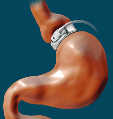 Gastric Banding Surgery at CK Birla