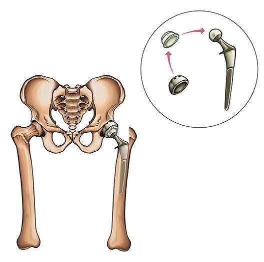 Unilateral Hip Replacement at Marengo Asia, Gurgaon, India