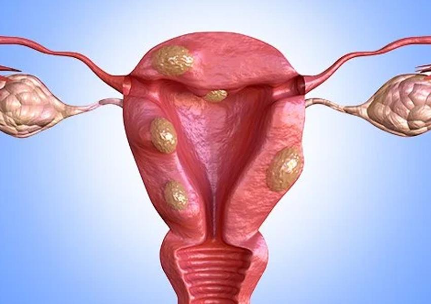 Laparoscopic Myomectomy at CK Birla Hospital, Gurgaon