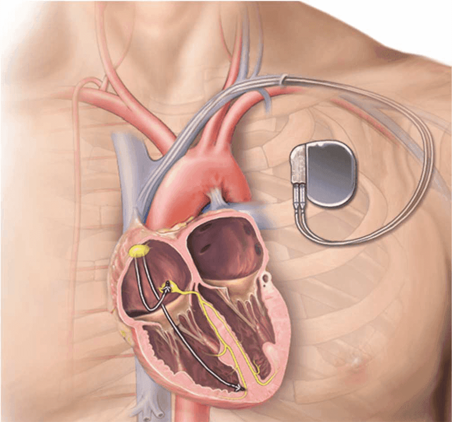 Pacemaker Implantation at Paras, Gurgaon, India
