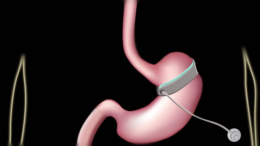 Gastric Banding at Lokman Hekin, Istanbul