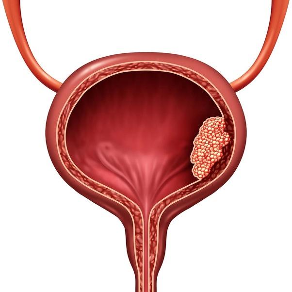 transurethral resection of the prostate (TURP)
