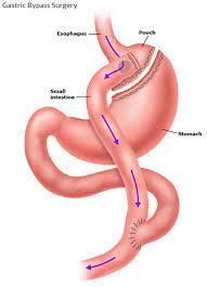 Gastric Bypass Surgery at CK Birla, Gurgaon, India
