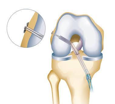 ACL Reconstruction at Medical Park