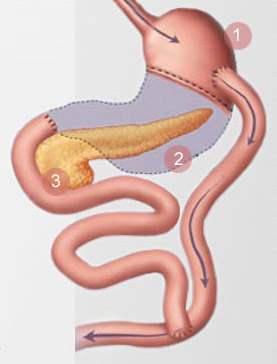 Gastric Bypass Surgery at Saudi German Dubai