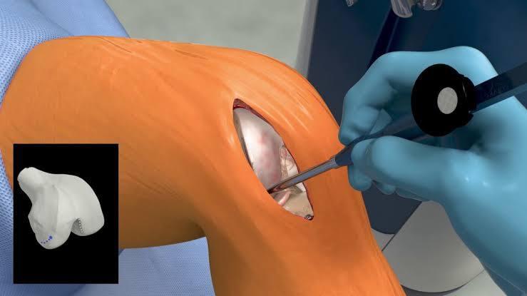 Unilateral Knee Replacement at Marengo Asia, Gurgaon, India