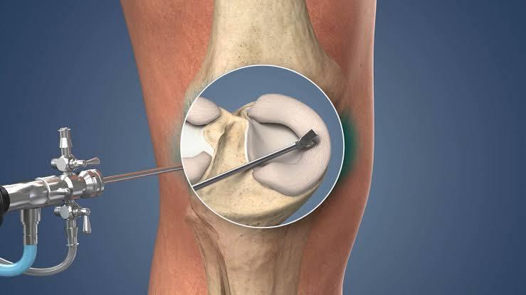 Knee Arthroscopy at Medical Park