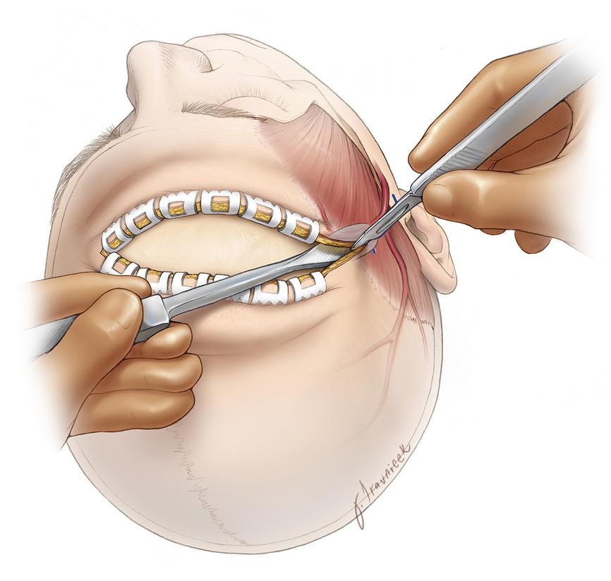 Craniotomy Surgery at Saudi German Hospital, Dubai