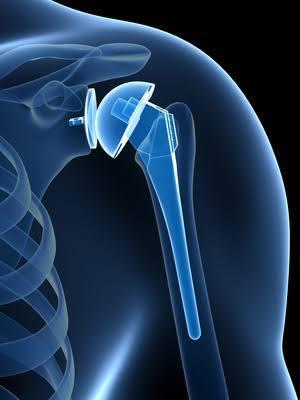 Shoulder Replacement at Medicana Istanbul