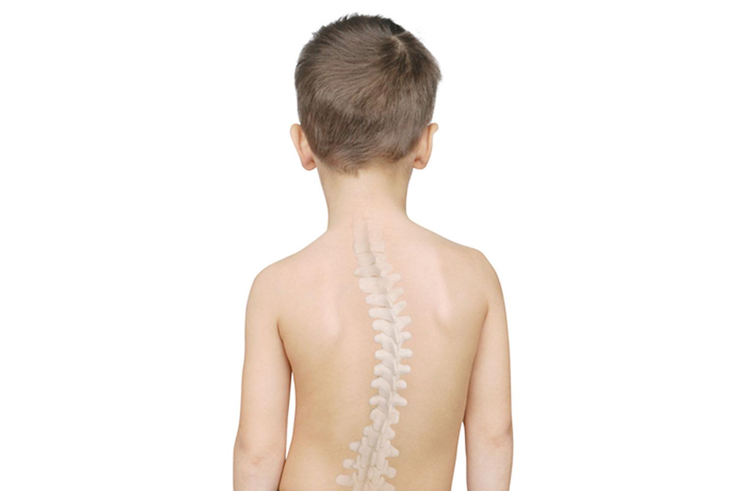 Scoliosis Spine Surgery at Medicana, Istanbul, Turkey