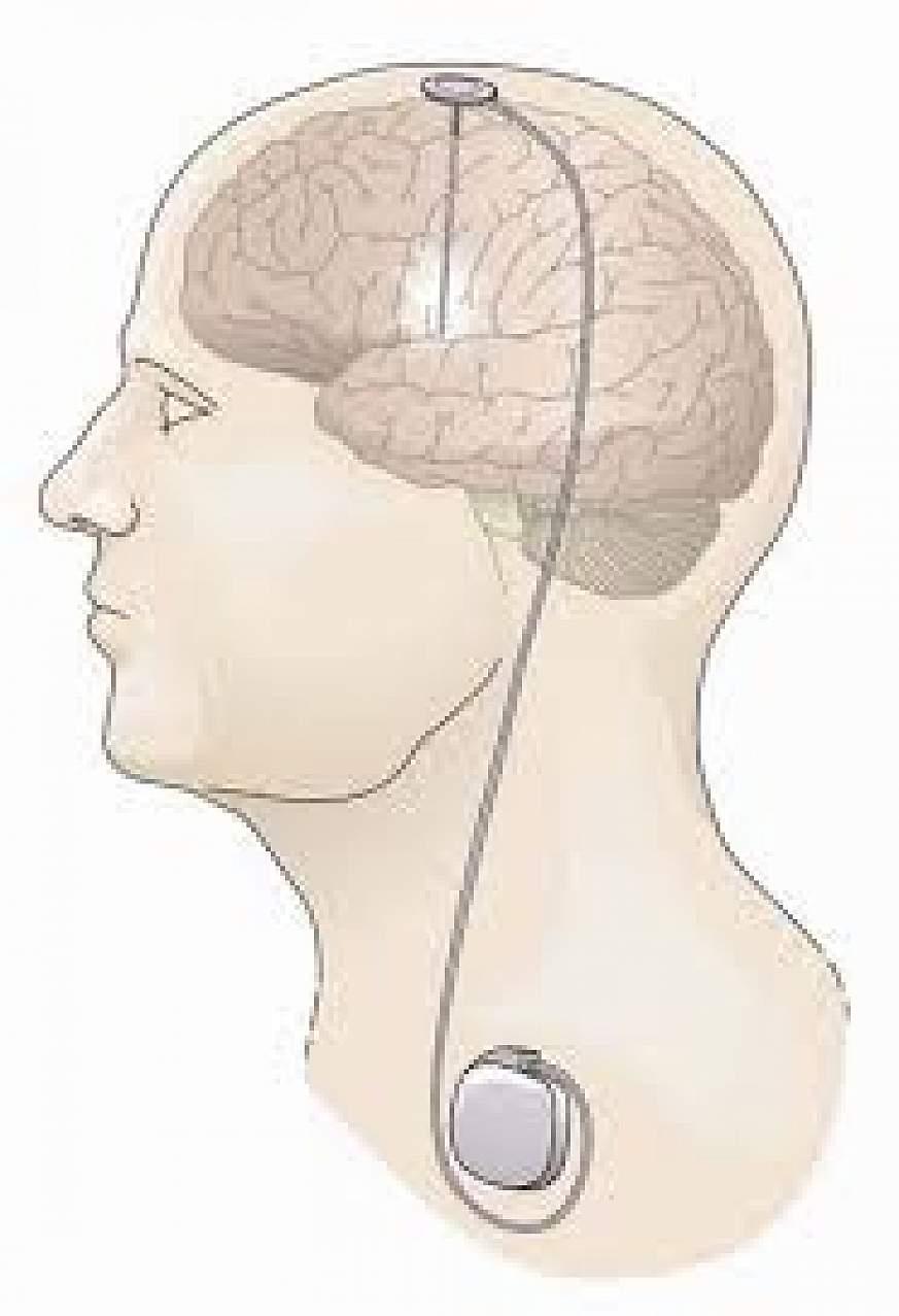 Deep Brain Stimulation at Saudi German Hospital, Dubai
