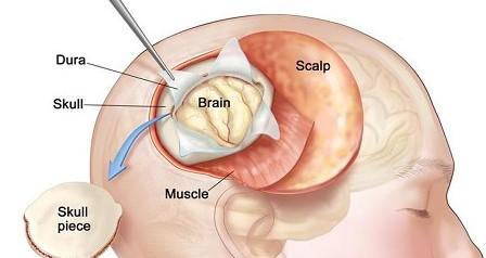 Brain Tumor Excision Surgery at Artemis Hospital, Gurgaon
