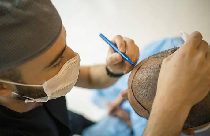 Hair Transplant at Aster Hospital, Dubai, UAE