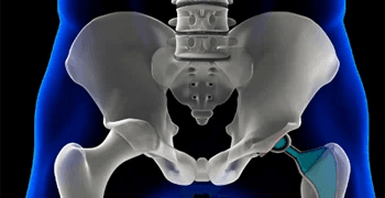 Unilateral Hip Replacement at Max, New Delhi, India