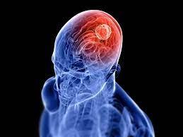 Brain Tumor Excision Surgery at Max Hospital, Gurgaon