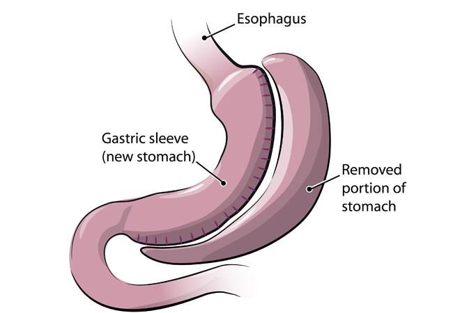 Gastric Sleeve Surgery at Lokman Hekin, Istanbul, Turkey