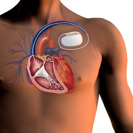 Pacemaker Implantation at Medical Park, Istanbul, Turkey