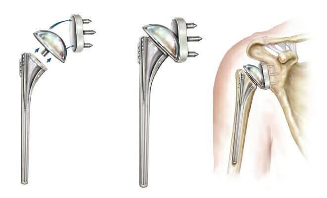 Shoulder Replacement at Marengo Asia