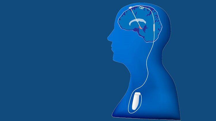 Deep Brain Stimulation at Manipal Hospital, Bangalore
