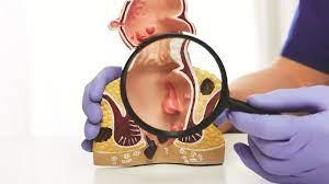 Hemorrhoidectomy at BLK-Max Super Speciality Hospital