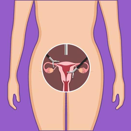 Laparoscopic Hysterectomy at American Hospital, Istanbul