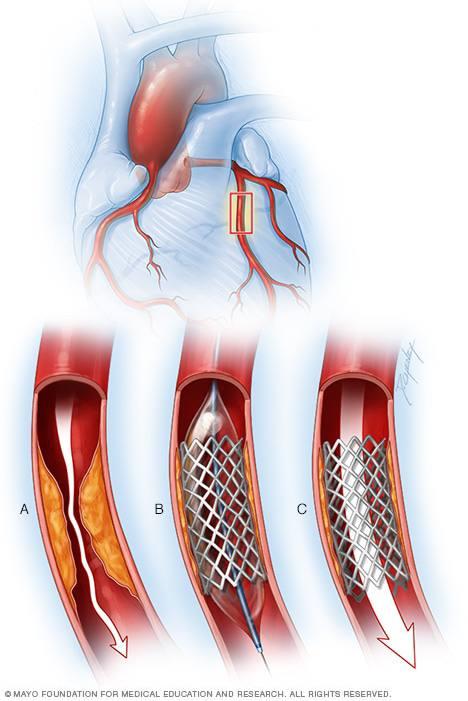 Coronary Angioplasty at Fortis Escorts, New Delhi, India