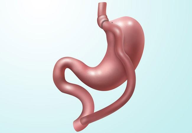 Gastric Bypass Surgery at Lokman Hekin Istanbul, Turkey