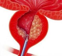 Transurethral resection of the prostate (TURP) at Artemis Hospital, Gurgaon