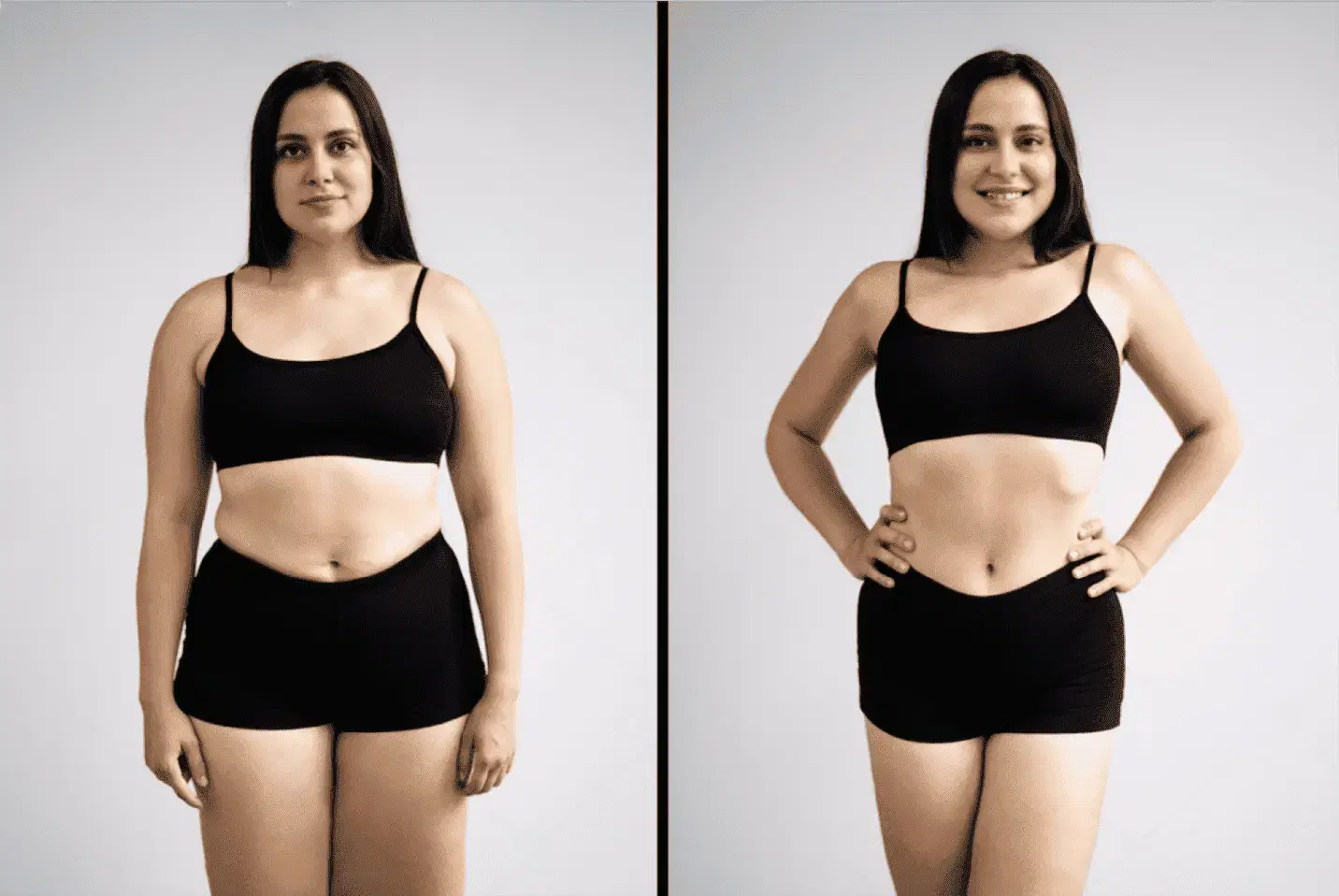 Liposuction Surgery at Medicana International - Yapita Health