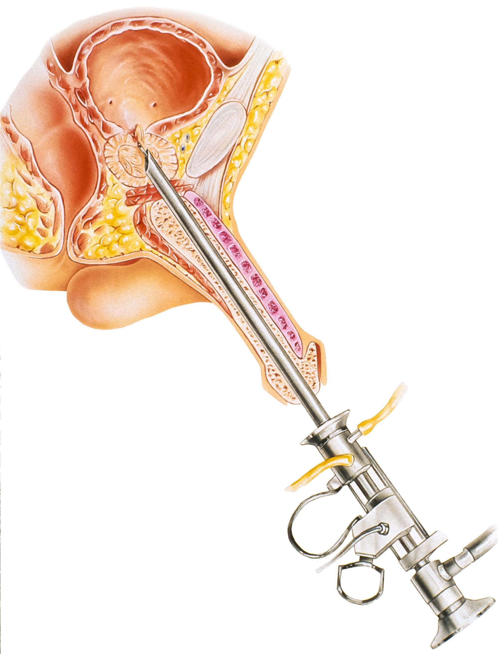 Transurethral resection of the prostate (TURP)