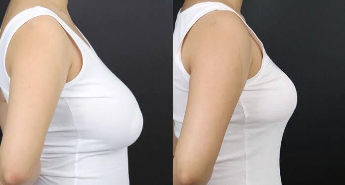 Breast Augmentation at CK Birla Hospital, Gurgaon, India