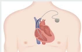 Pacemaker Implantation at Fortis Escorts, New Delhi, India