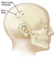 Craniotomy Surgery at Max Hospital, Gurgaon