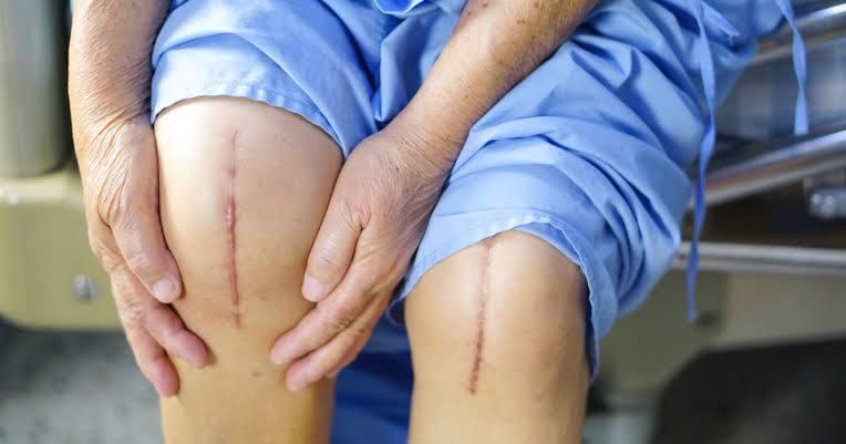 Bilateral Knee Replacement at Artemis, Gurgaon, India