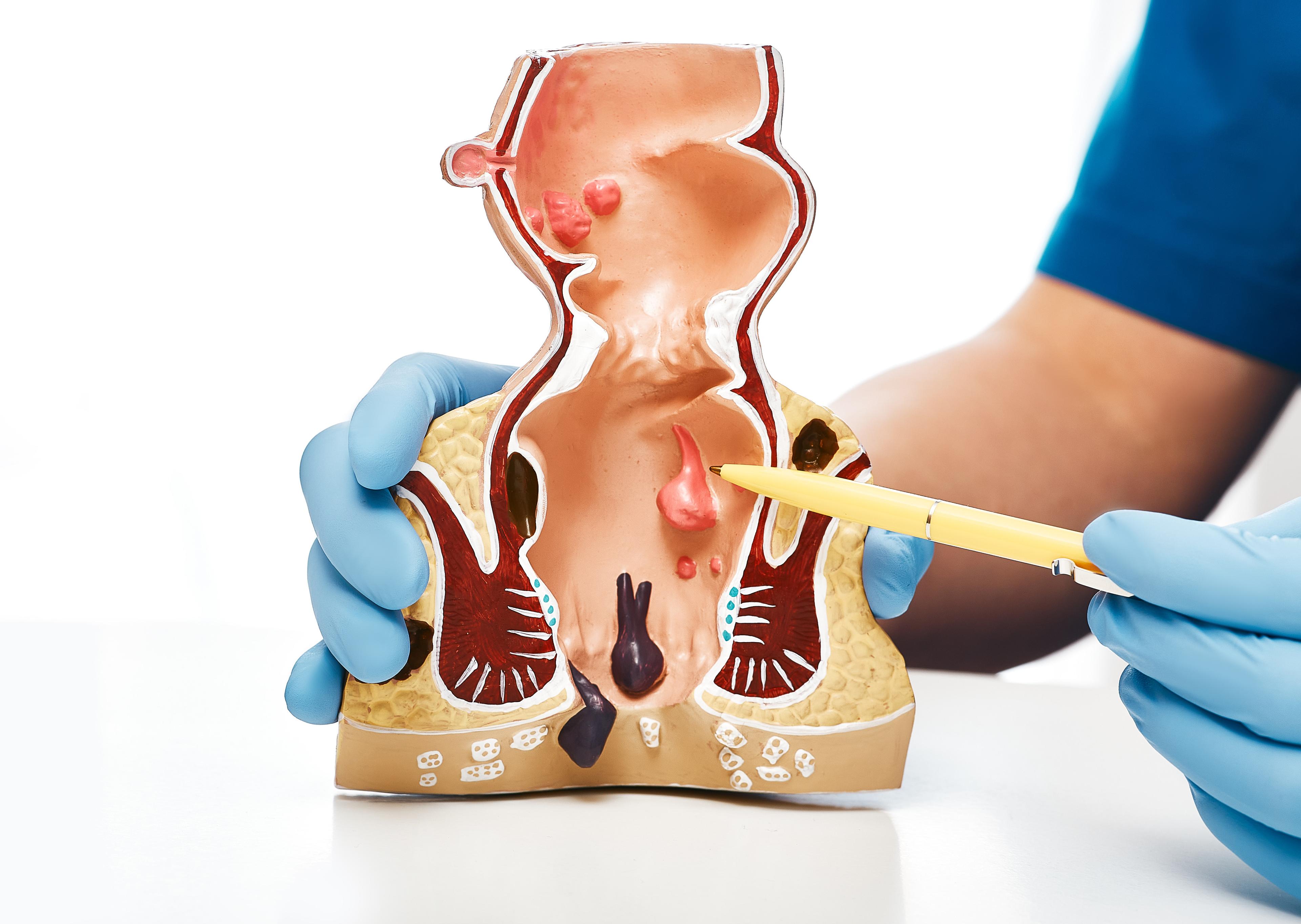Hemorrhoidectomy at Marengo Asia Hospitals