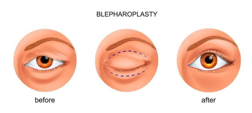 Blepharoplasty (Eye Lid) at Lokman Hekim