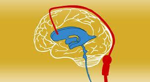 VP Shunt Surgery at Artemis Hospital, Gurgaon