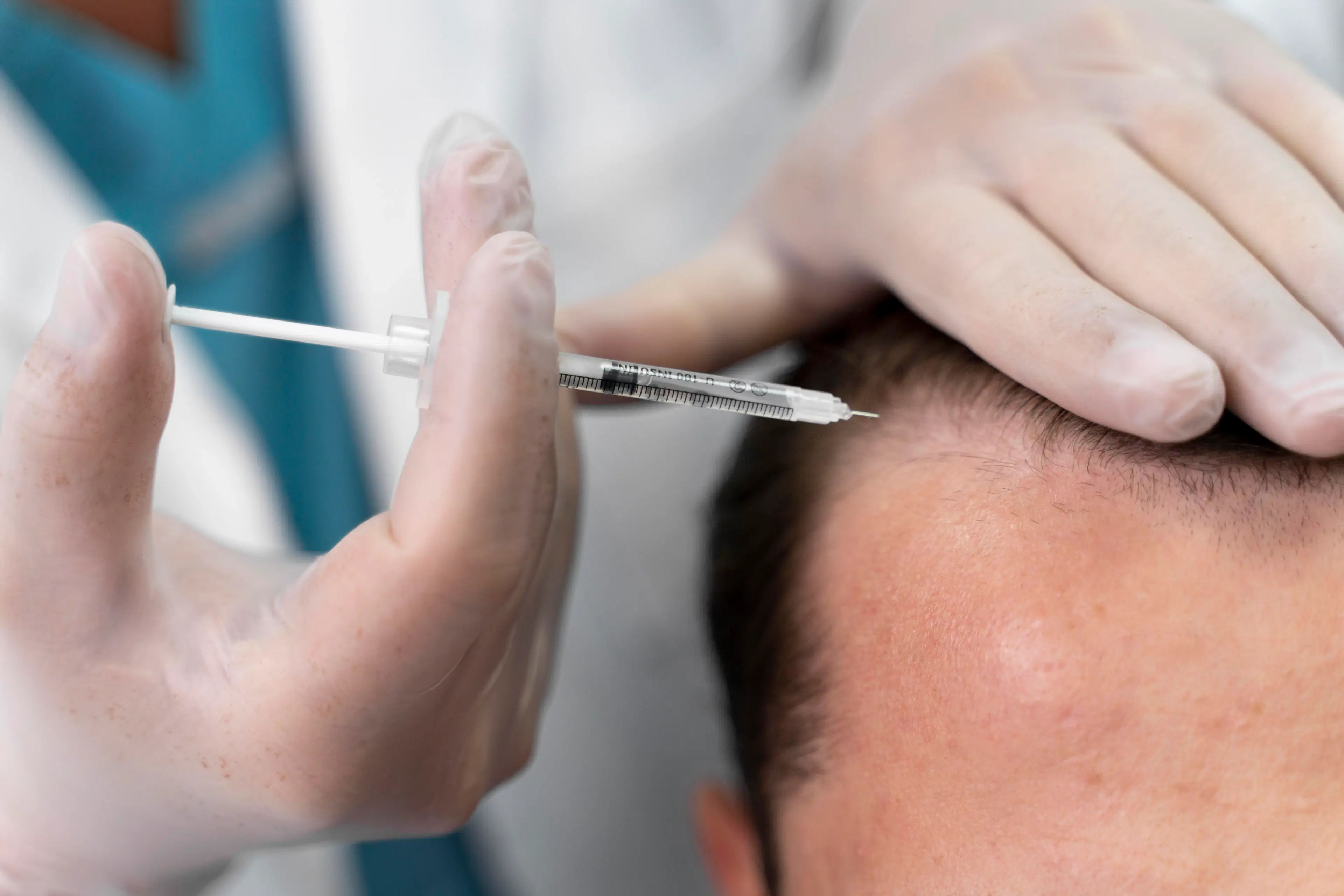 Hair Transplant at Long Hair Center Istanbul, Turkey (with Flight)