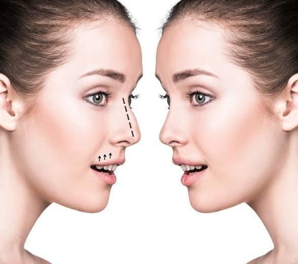 Septoplasty at Saudi German Dubai