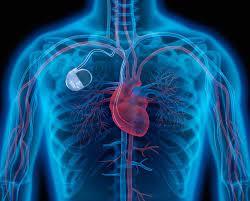 Pacemaker Implantation at Medicana, Istanbul, India