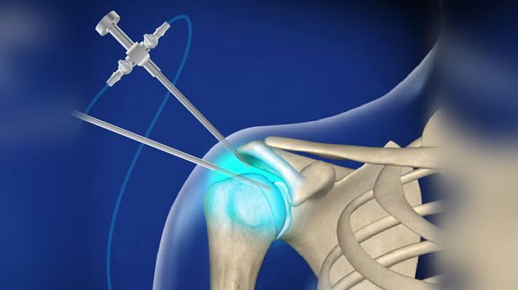 Shoulder Arthroscopy at Saudi German Dubai, UAE
