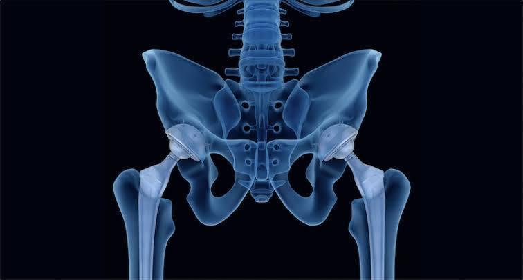 Bilateral Hip Replacement at Wockhardt, Mumbai, India
